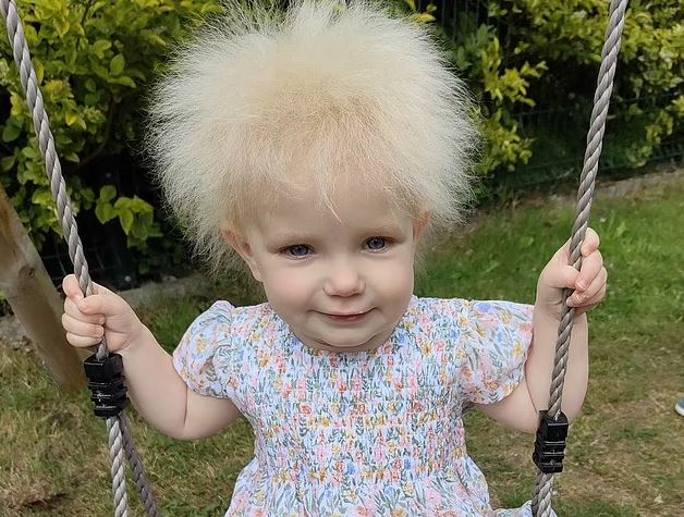 کودک ۱۷ ماهه مبتلا به سندرم موهای شانه نشدنی (+عکس و فیلم) کودک ۱۷ ماهه مبتلا به سندرم موهای شانه نشدنی (+عکس و فیلم)