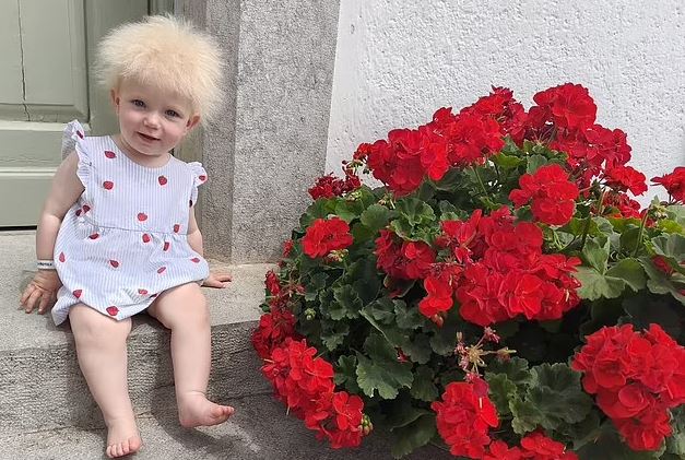 کودک ۱۷ ماهه مبتلا به سندرم موهای شانه نشدنی (+عکس و فیلم) کودک ۱۷ ماهه مبتلا به سندرم موهای شانه نشدنی (+عکس و فیلم)