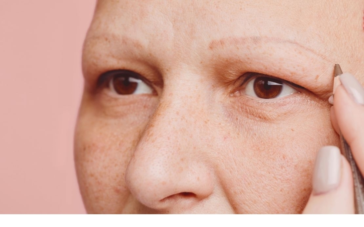 زندگی با وجور بیماری آلوپسی (ریزش مو)