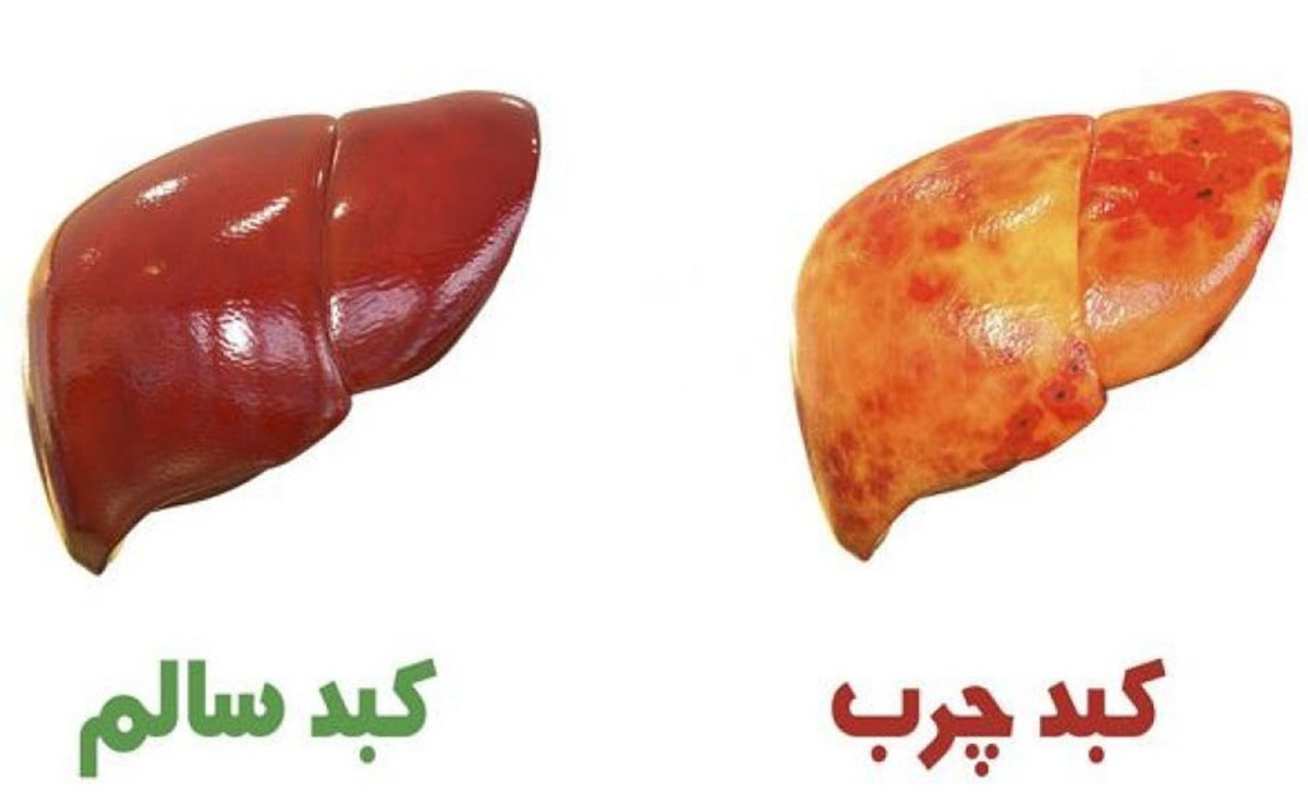 ارتباط خارش شبانه با بیماری کبد