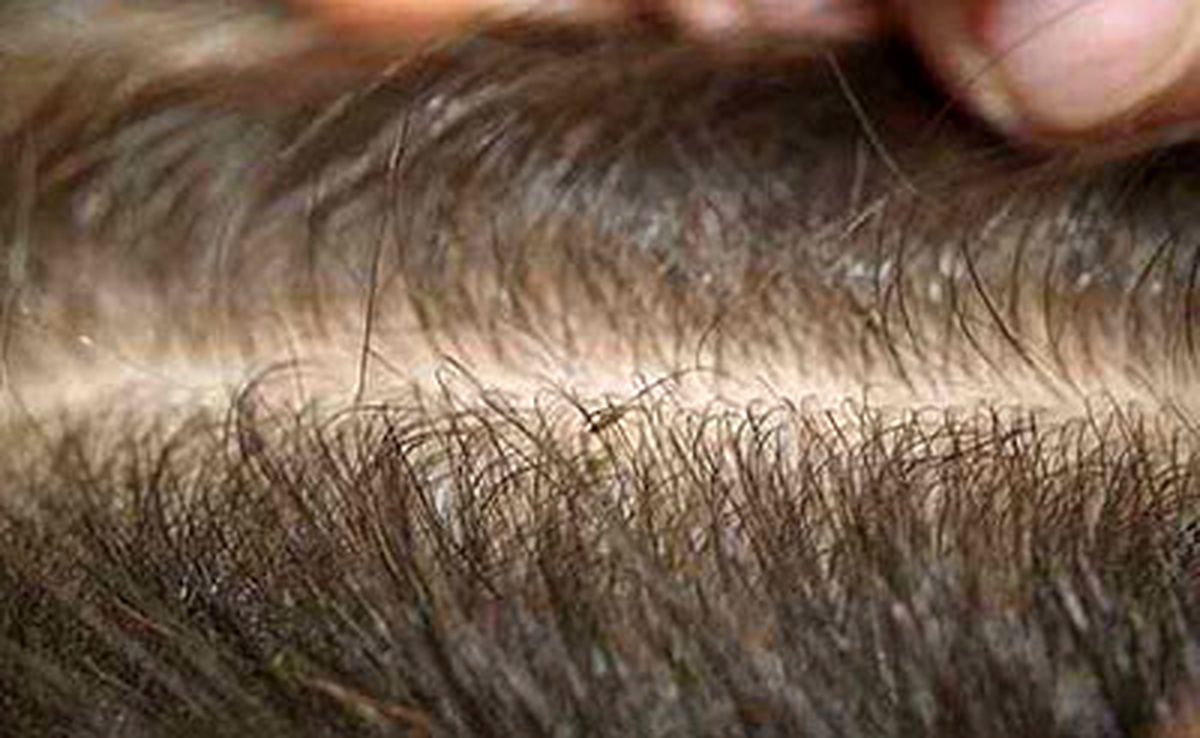 هر آنچه که باید در مورد شپش بدانیم