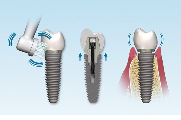 دلیل بالا بودن قیمت ایمپلنت دندان چیست؟ دلیل بالا بودن قیمت ایمپلنت دندان چیست؟