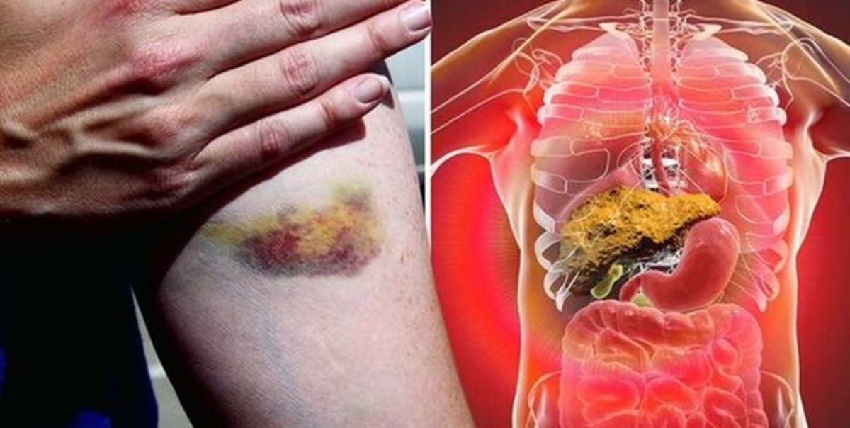 علامتی که می‌تواند نشانه ابتلا به کبد چرب باشد