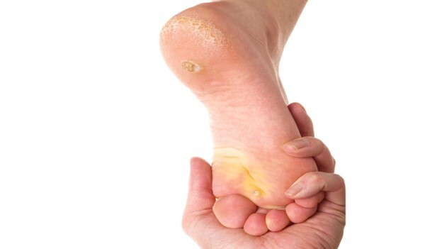 درمان زخم دیابتی در منزل