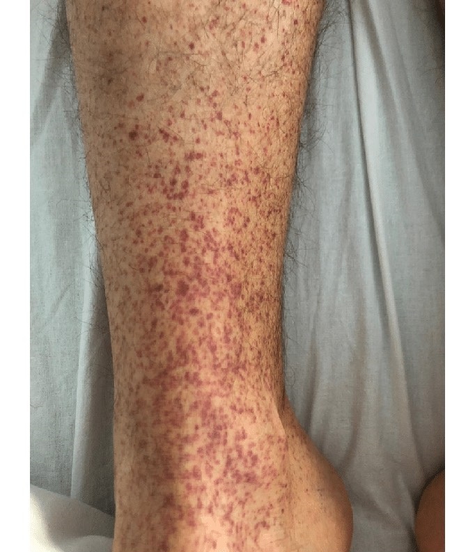 پتشی: علل، علائم و درمان/ چه زمانی به پزشک مراجعه کنیم(+عکس) پتشی: علل، علائم و درمان/ چه زمانی به پزشک مراجعه کنیم(+عکس)