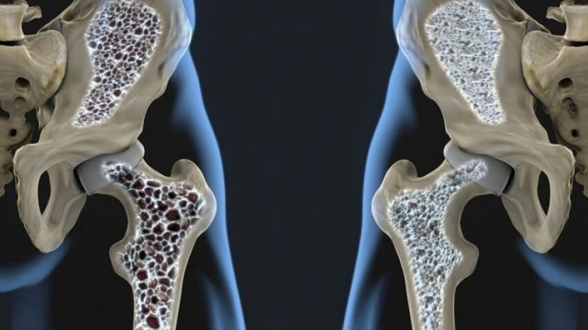 دانشگاه علوم پزشکی: هر 3 ثانیه یک شکستگی به علت پوکی استخوان در جهان رخ می دهد