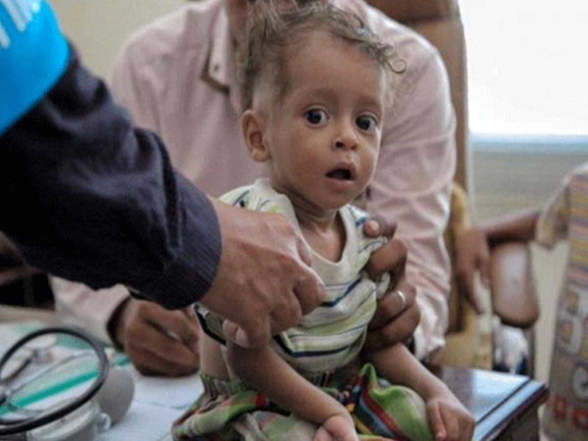 یونیسف: هر ۱۰ دقیقه یک کودک یمنی می‌میرد/ بیش از ۵۴۰ هزار کودک زیر پنج سال در یمن به سوءتغذیه حاد و تهدیدکننده مبتلا هستند