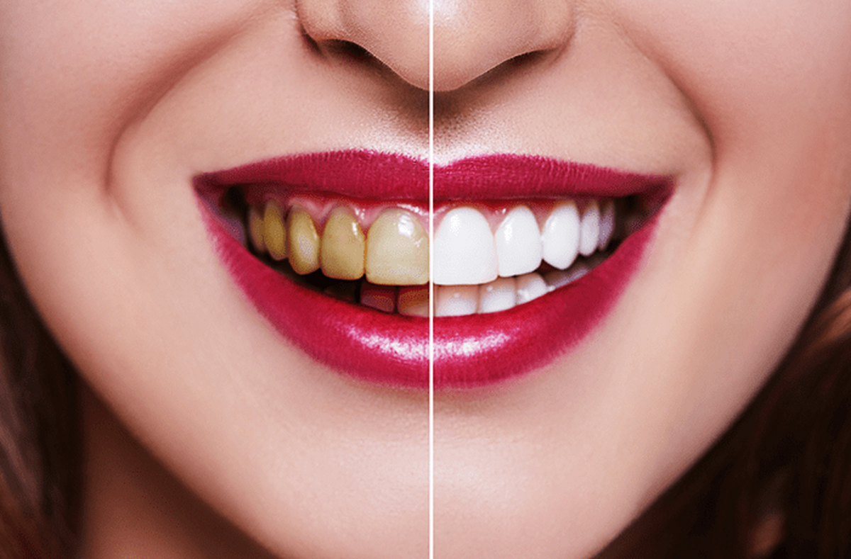 این ۱۰ خوراکی‌ دندان‌های شما را زرد می‌کنند
