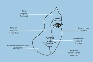 آکنه در هر قسمت بدن چه علتی دارد؟ (+اینفوگرافیک)