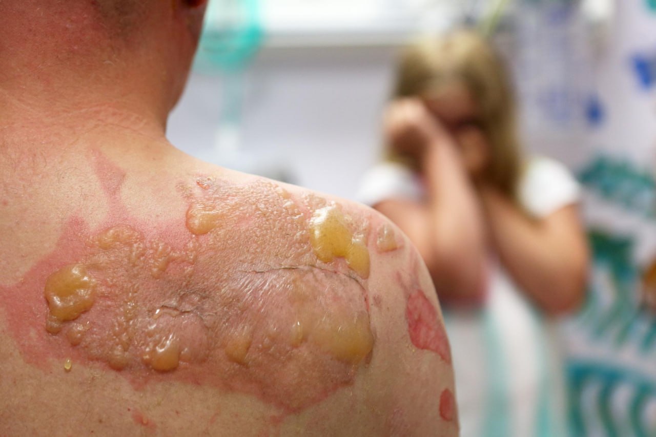 پمفیگوس چیست و چه علائمی دارد؟ پمفیگوس چیست و چه علائمی دارد؟