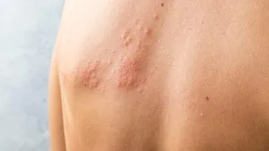دردناک‌ترین بیماری محتمل بهاری!/ چرا در این فصل شیوع بیماری بیشتر است؟/ طب سنتی چه نظری دارد؟