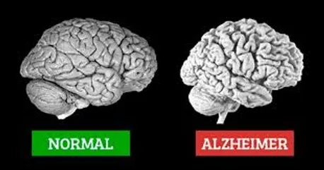   آلزایمر چیست، نشانه هایش کدام است و چه کنیم مبتلا نشویم؟