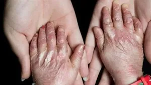 شناسایی ۴۹۲ گونه بیماری نادر و چالش‌های هزینه‌های درمانی در ایران