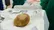 سریلانکا: سنگ ۳ کیلویی از مثانه یک مرد ۵۵ ساله خارج شد(+عکس)