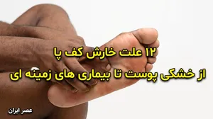 ۱۲ علت خارش کف پا؛ از خشکی پوست تا بیماری های زمینه ای