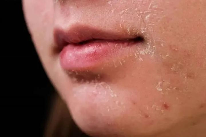 علائم خشکی پوست صورت علائم خشکی پوست صورت