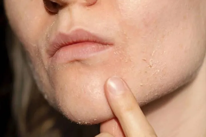 علائم خشکی پوست صورت علائم خشکی پوست صورت